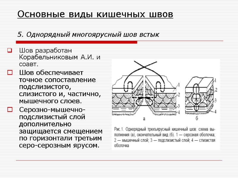 Основные виды кишечных швов  5. Однорядный многоярусный шов встык  Шов разработан Корабельниковым